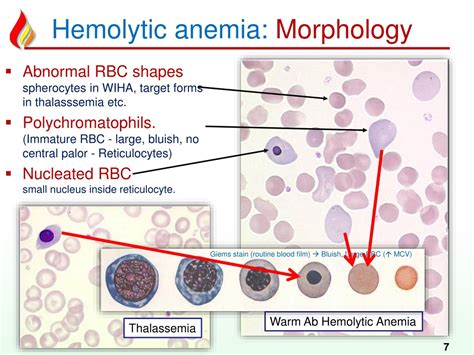 Hemolytic Anemia .